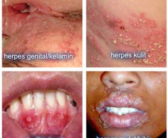 obat alami herpes bibir