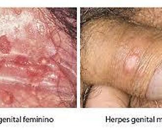 obat herpes kulit untuk anak