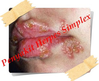 obat herpes biar cepat kering