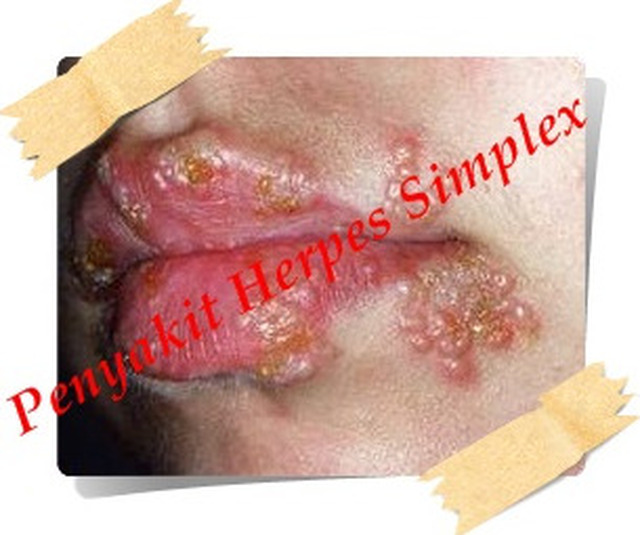 obat herpes antibiotik
