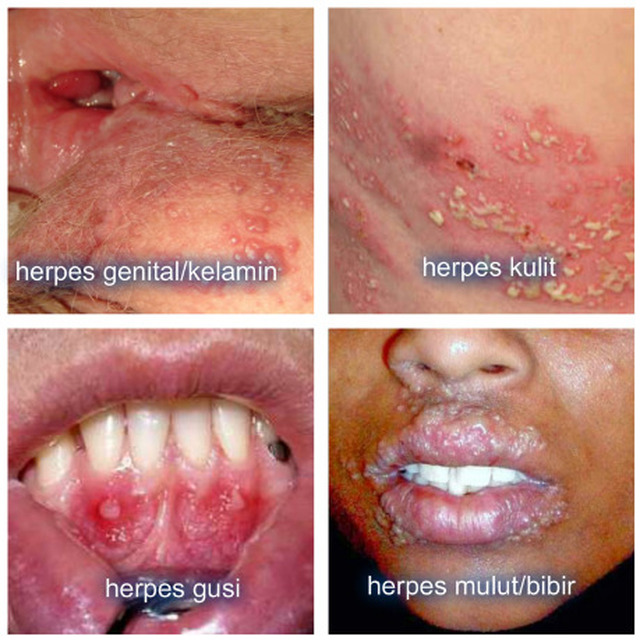 obat herbal herpes genital