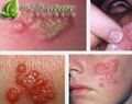 obat tradisional herpes bibir