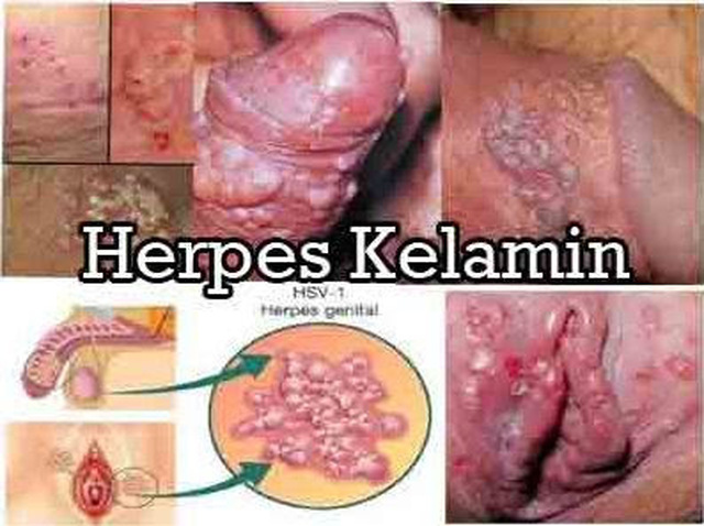 Obat Penyakit Herpes Kemaluan Herbal Manjur