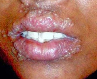 cara menyembuhkan penyakit herpes pada wajah