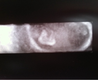 Første ultralyd