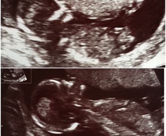 Min graviditet: Ultraljuden