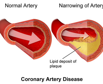 LCHF og kolesterol