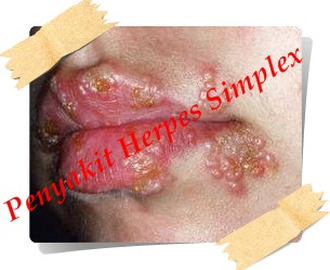 obat herpes atau dompo