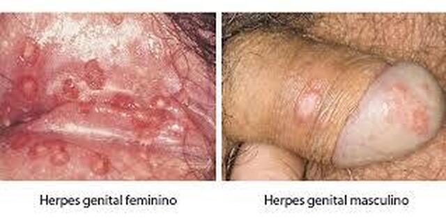 obat herpes kulit untuk anak