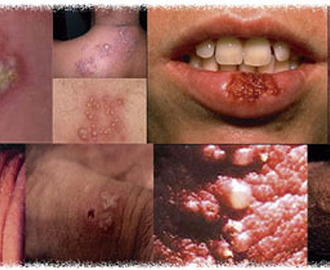 obat herpes kulit