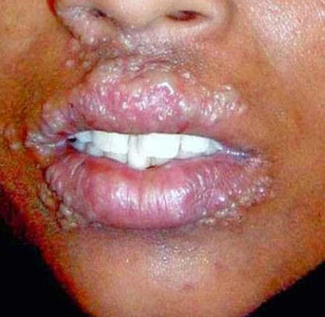 cara menyembuhkan penyakit herpes pada wajah